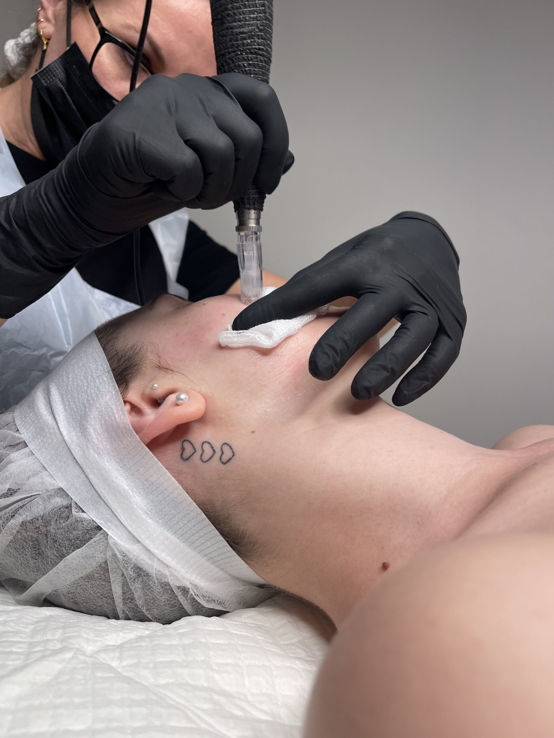 BEAUTY-INK-Microneedling- (4)